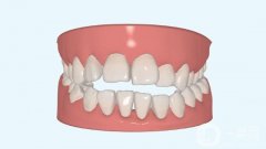常德矯正牙齒一般多少錢？價目表2024版，靠譜醫(yī)院推薦
