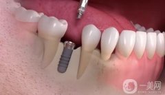 邵陽一顆種植牙要多少錢？收費價格表公布，一鍵查收