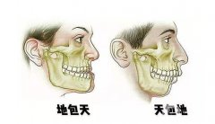 凸嘴正頜手術(shù)多少錢？手術(shù)時間、注意事項介紹詳細