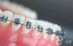 巴南區(qū)牙齒矯正費用多少錢？正畸這五點你不得不知道