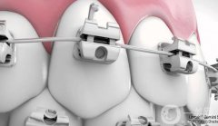 潮州牙齒矯正多少錢？收費(fèi)標(biāo)準(zhǔn)解答，附牙科機(jī)構(gòu)預(yù)選！