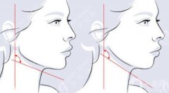 削顴骨要多少錢？全新價(jià)格費(fèi)用揭曉，機(jī)構(gòu)一鍵了解