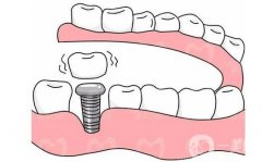 鄭州種植牙價(jià)格貴不貴？多少錢？全新口碑牙科醫(yī)院推薦