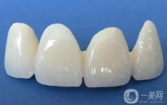 烏魯木齊烤瓷牙多少錢？烤瓷牙的適宜人群盤點(diǎn)