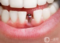 無錫種一顆牙價格多少錢？種植牙品牌怎么選？附五家靠譜醫(yī)院介紹