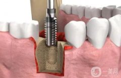 珠海種植牙價格表2024全新公布！植牙機(jī)構(gòu)+步驟一文全解析