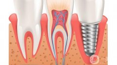 南昌種植牙多少錢一顆？價格費用概況解析，附高性價比醫(yī)院盤點
