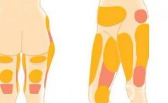 減肥抽脂術(shù)要多少錢？效果如何？盤點四家口碑醫(yī)院了解一下！