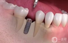 佛山種牙多少錢一顆??？價格費用詳細(xì)_靠譜醫(yī)院測評3家