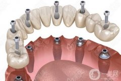 三亞種一顆牙多少錢？種植牙步驟和階段時間一文解答