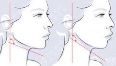 磨骨下頜角要多少錢？下頜角磨骨手術(shù)步驟、醫(yī)院這里了解！