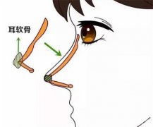 肋骨隆鼻多少錢？肋骨隆鼻和耳軟骨哪個好？醫(yī)院點評