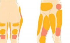 水動力吸脂如何？是否會導(dǎo)致皮膚松弛呢