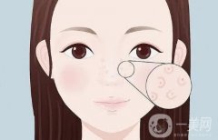 填充蘋果肌的作用有哪些？