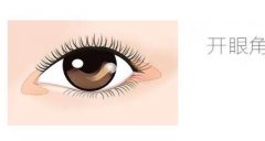 微創(chuàng)雙眼皮手術(shù)的效果可以永久嗎？