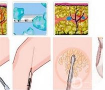 小腿吸脂后痛嗎，多久能恢復呢？