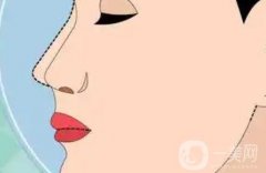 延長鼻小柱后的恢復期長嗎？有后遺癥嗎？