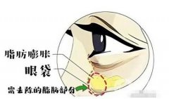 眼袋去除手術(shù)失敗怎么辦？
