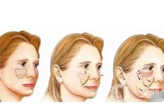 自體脂肪填充前額的效果如何