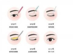 做雙眼皮手術(shù)具體有哪些好處呢？