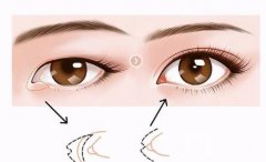 開眼角手術(shù)失敗修復的成本貴嗎？