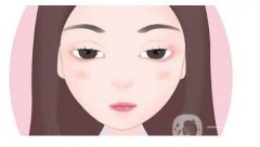 開眼角拆線后的注意事項