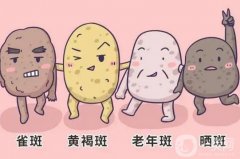 雷射美白祛斑的注意事項