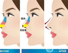 隆鼻修復(fù)后可能出現(xiàn)的問題或并發(fā)癥