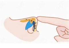 埋線減肥的禁忌和注意事項