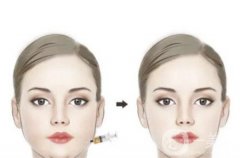 面部吸脂怎么樣，適合哪些人