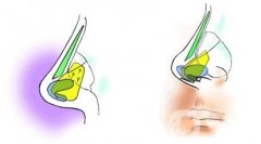 哪些情況下適合進(jìn)行鼻孔縮小手術(shù)呢？