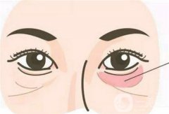 去除眼袋手術怎么樣