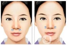 取出硅膠隆鼻假體的概率大不大