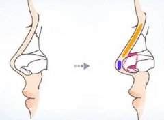 如何應對膨體隆鼻后的效果不理想？