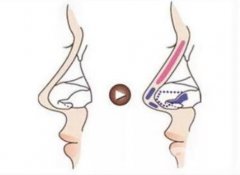 鼻頭縮小手術(shù)的優(yōu)勢(shì)及是否會(huì)反彈