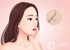 鼻綜合有后遺癥嗎？要注意哪些事項(xiàng)