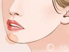玻尿酸墊下巴有沒(méi)有后遺癥