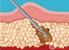 杭州正規(guī)醫(yī)院抽脂肪要多少錢？杭州正規(guī)整形醫(yī)院吸脂收費揭曉~
